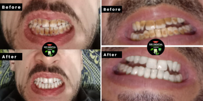 Amazing Teeth Transformation