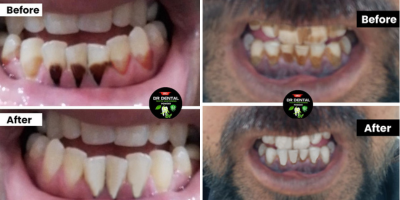 Tea Stain Removal Success